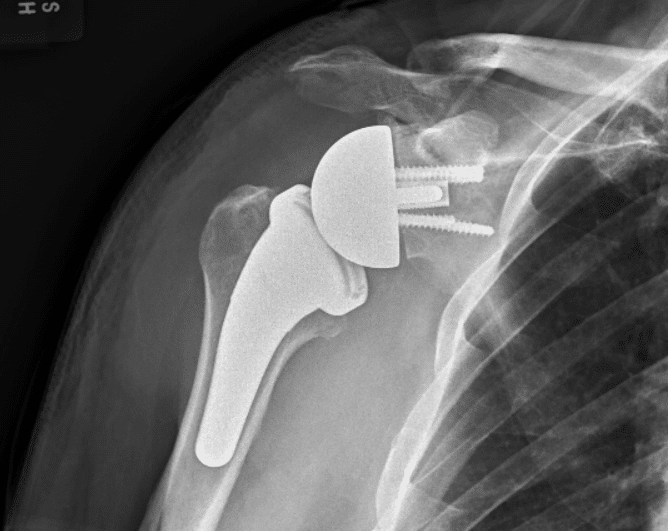 what is the difference between standard and reverse shoulder replacement 62767fa2b1d72