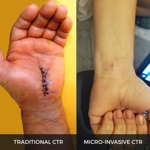 traditional vs micro invasive ctr