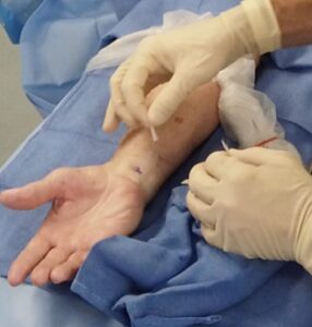 The small incision used by Raleigh's Carpal Tunnel Surgeon 
