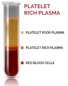 platelet rich plasma diagr upd 237x300