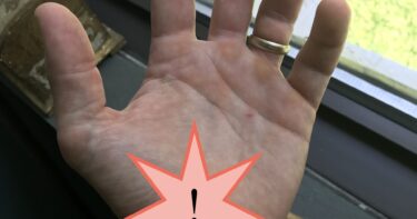 painful hand