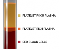 platelet rich plasma diagr upd 237x300